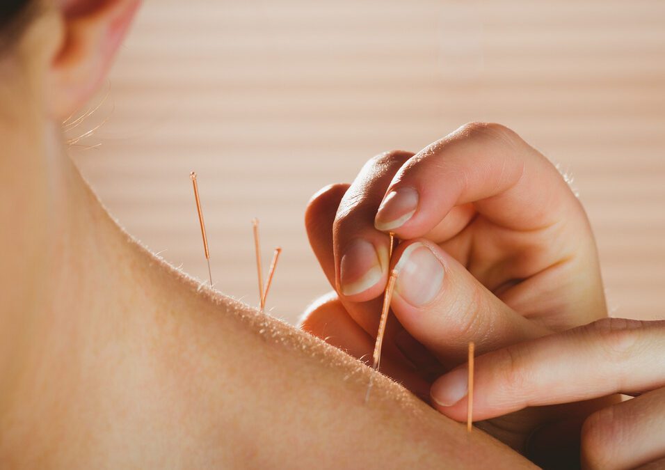 Patient Testimonial- Dry needling To Treat Shoulder Pain