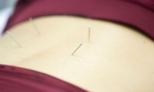 Dry Needling Before Surgery Decreases Pain After Total Knee Replacement